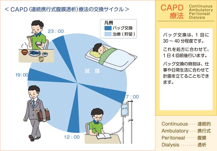 CAPD（連続携行式腹膜透析）療法の交換サイクル