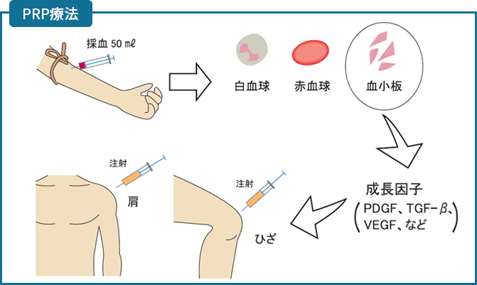 PRP療法